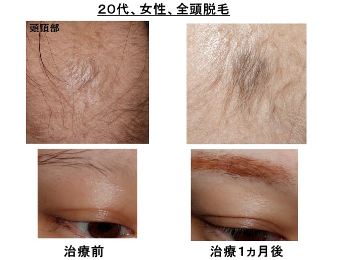 汎発性脱毛　病院